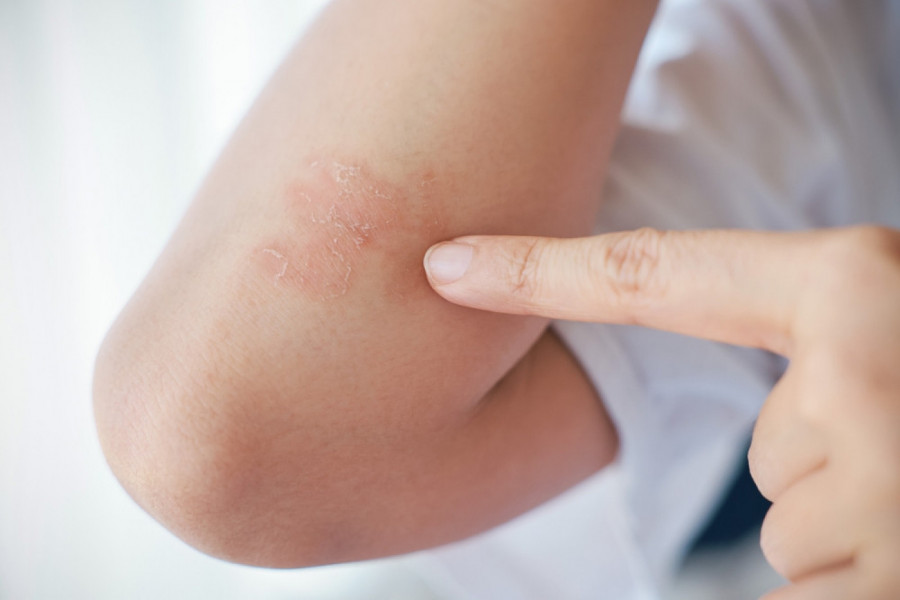 JA SAM DERMATOLOG, OVO SU DVA SIMPTOMA RAKA KOŽE KOJI SKORO SVIMA PROMAKNU: Ove signale nikako ne smete da ignorišete!