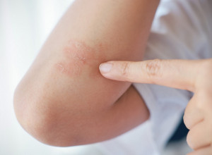 JA SAM DERMATOLOG, OVO SU DVA SIMPTOMA RAKA KOŽE KOJI SKORO SVIMA PROMAKNU: Ove signale nikako ne smete da ignorišete!