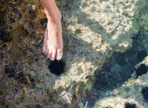 NAGAZILI STE NA MORSKOJ JEŽA NA PLAŽI, EVO ŠTA TREBA DA URADITE: Ova namirnica iz kuhinje pomaže da izvadite bodlje bez muke!
