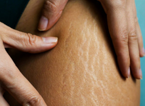 STRIJE MOGU ZAUVEK OSTAVITI TRAG NA VAŠOJ KOŽI: Evo kako da ih zaustavite na vreme